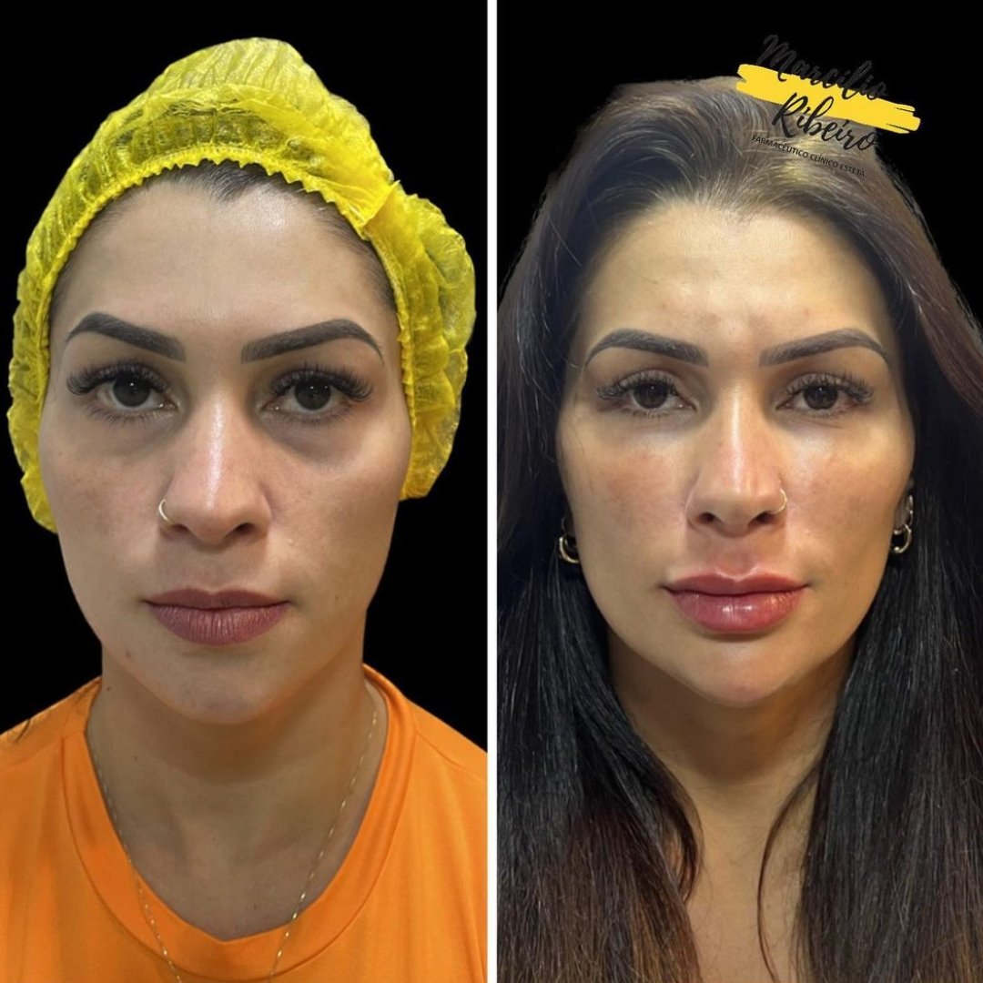 Harmonização Facial (2)