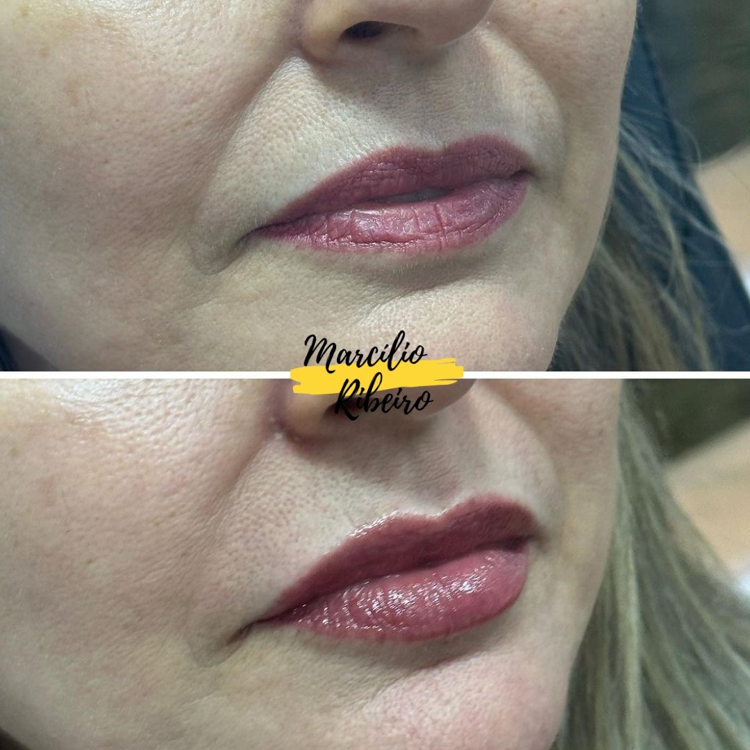 Preenchimento Labial (2)