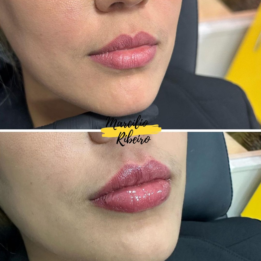 Preenchimento Labial (3)