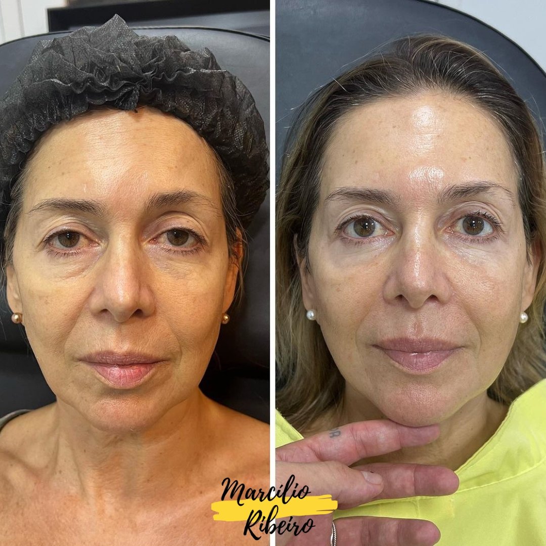 Rejuvenescimento Facial (2)