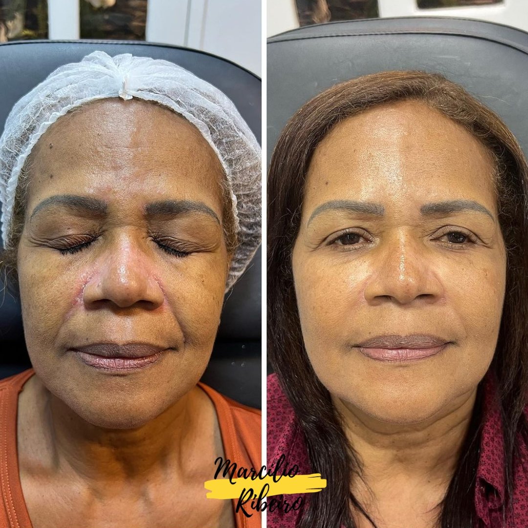 Rejuvenescimento Facial