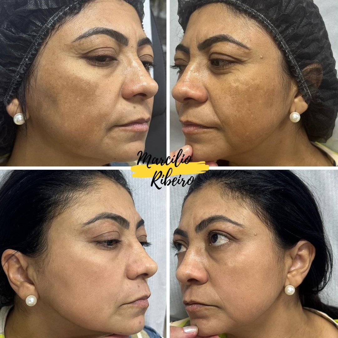 Tratamento de Melasma